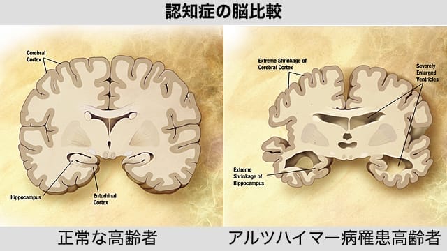 Alzheimer disease brain comparison
