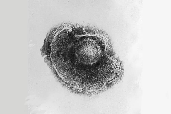 varicella zoster virus